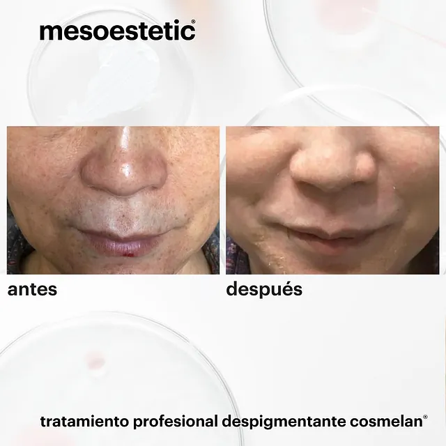 Sabina Leonte Centro de Estética Avanzada Montecarmelo antes y después de tratamiento facial